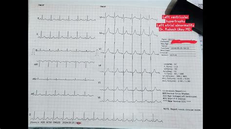 left ventricular hypertrophy lab tests.